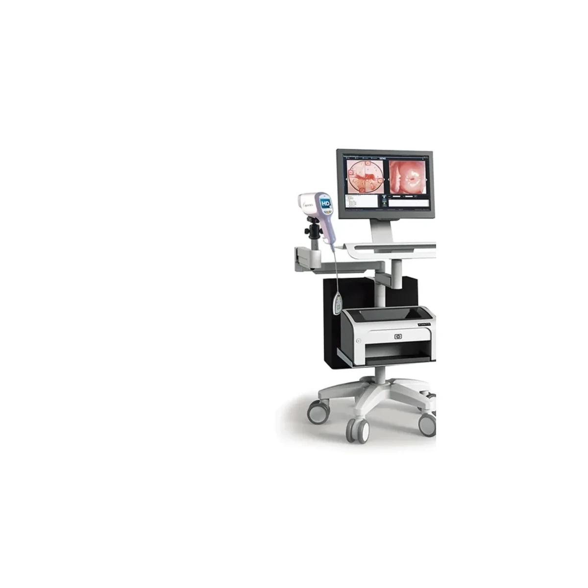 Video Colposcope